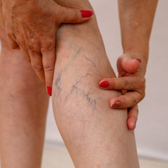Thread Veins