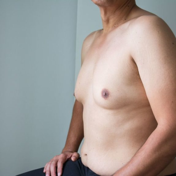 Gynaecomastia / Male Breast / Moob