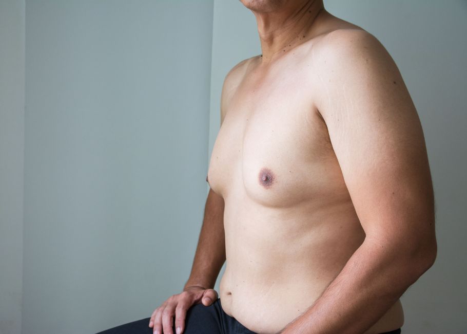Gynaecomastia / Male Breast / Moob