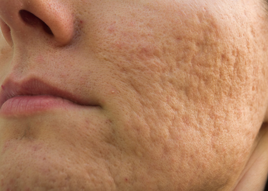 Acne Scaring