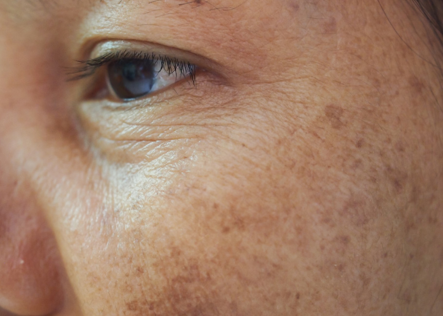 Age Spots