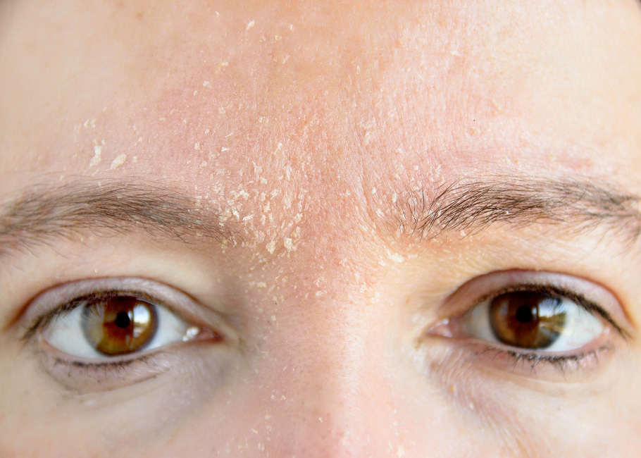 Dry Skin