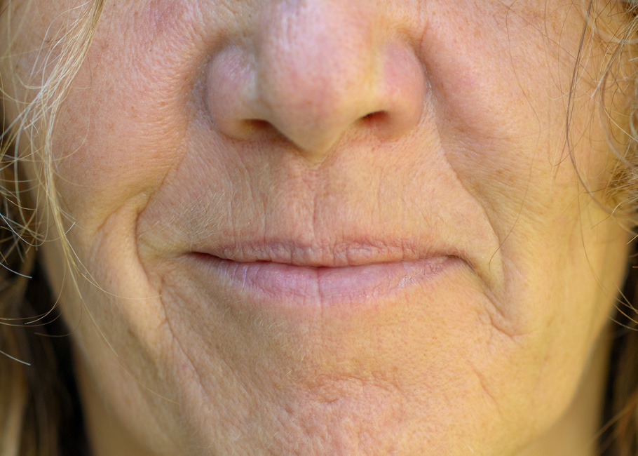 Facial Volume Loss