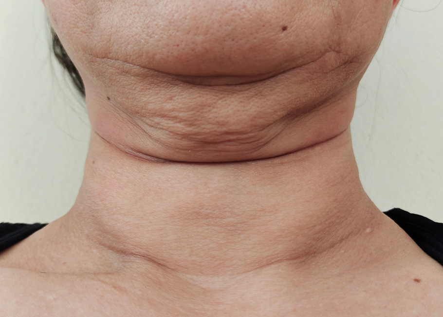 Loose or Sagging Skin