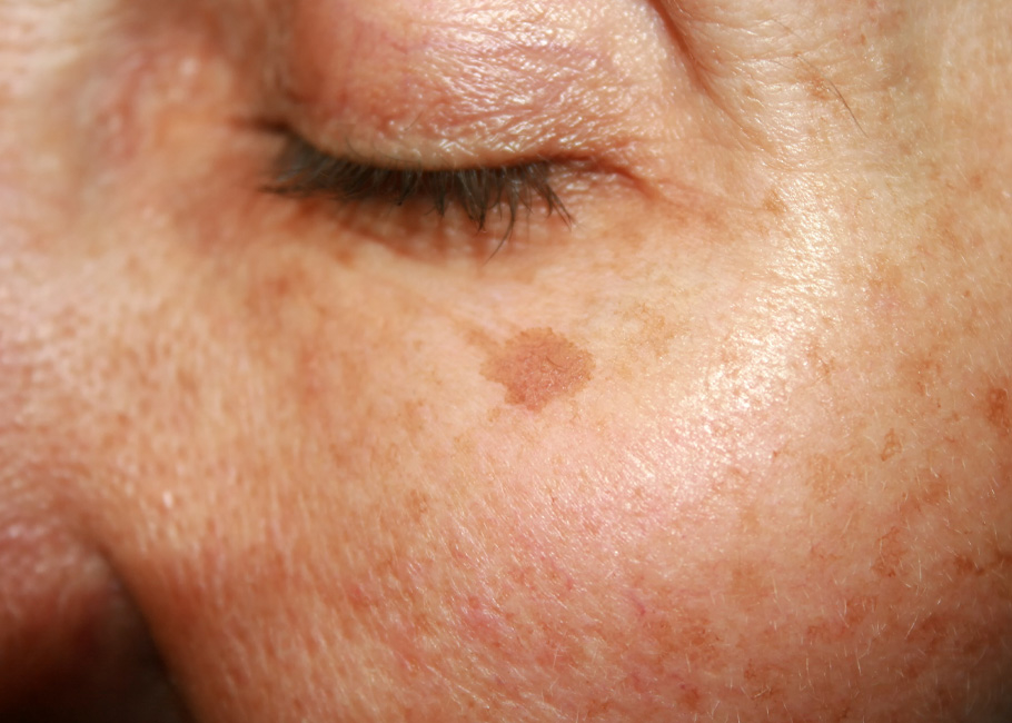Pigmentation