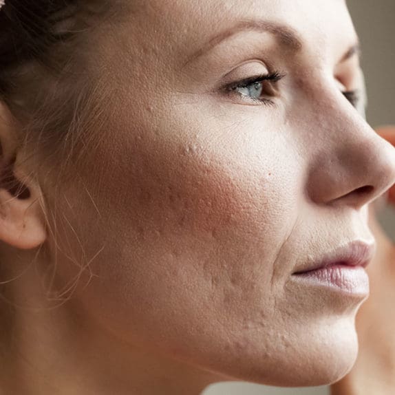 Acne Scarring