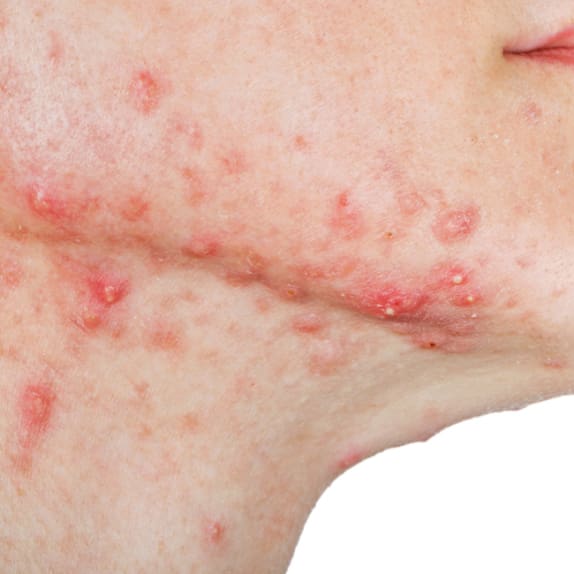 Acne