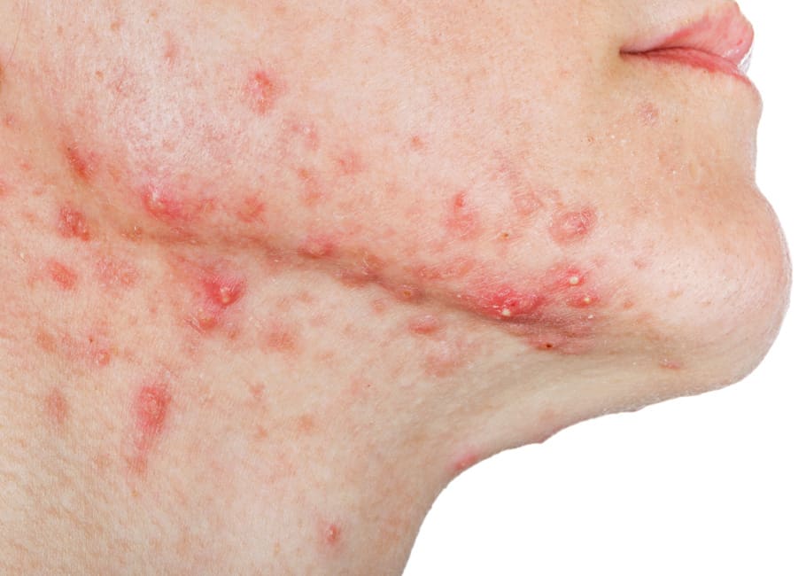 Acne