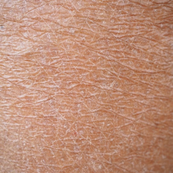 Dull/Dry Skin