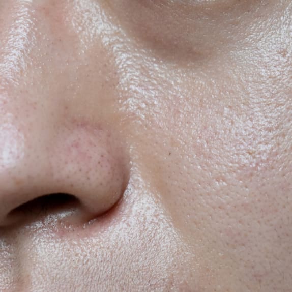 Oily / Congested Skin