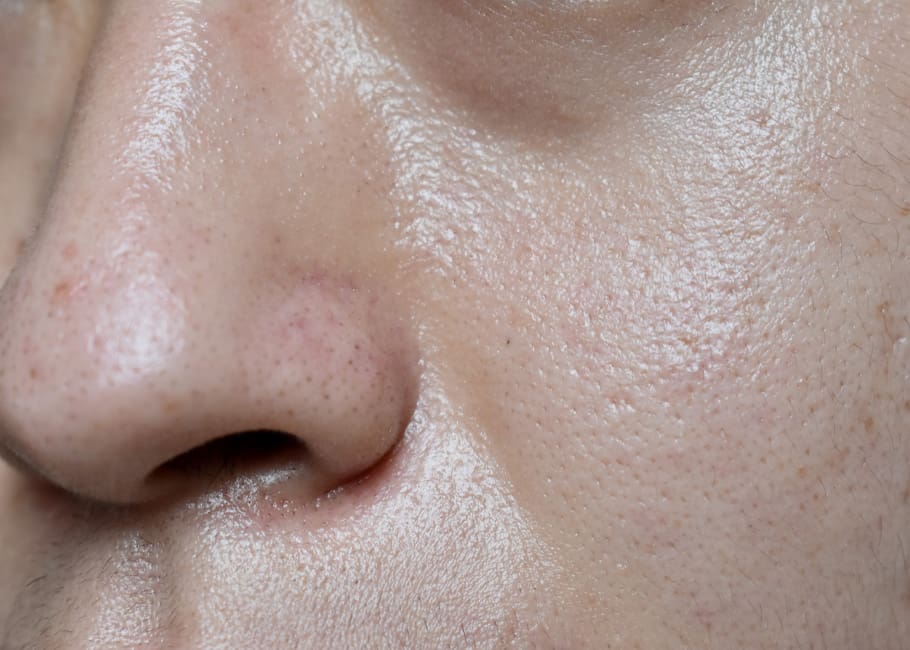 Oily / Congested Skin