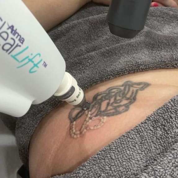 HARMONY XL PRO™ LASER ClearLift™  Tattoo Removal Protocol