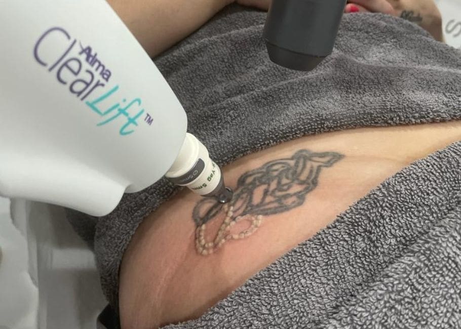 HARMONY XL PRO™ LASER ClearLift™  Tattoo Removal Protocol