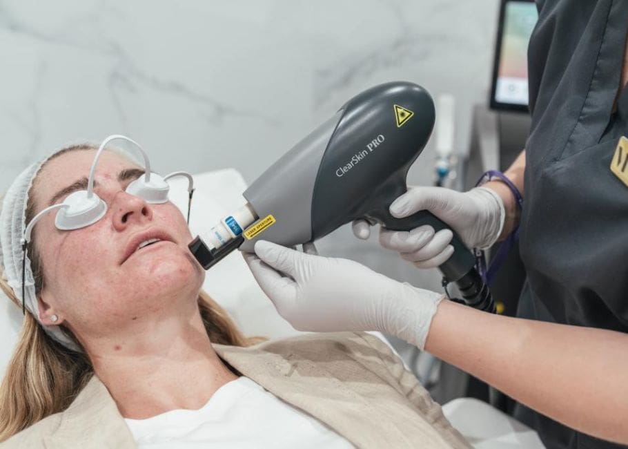 HARMONY XL PRO LASER ClearSkin PRO™ Acne Protocol