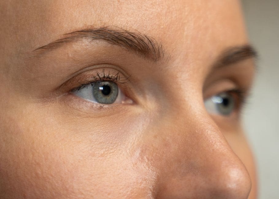 Astigmatism