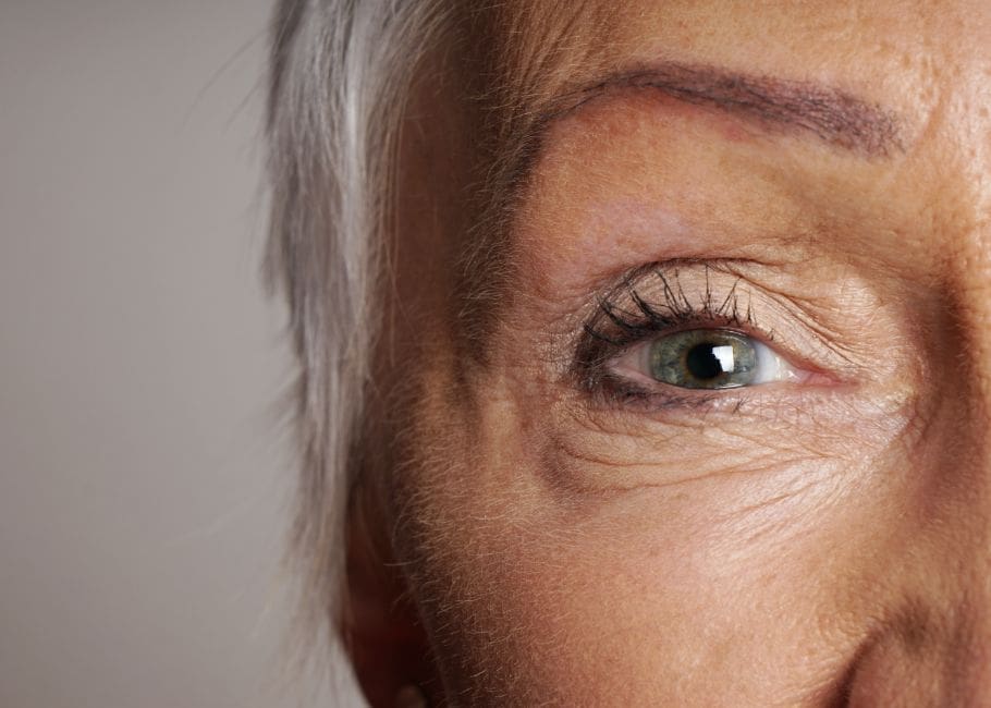 Cataract