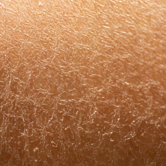 DULL DRY SKIN