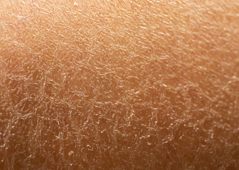 DULL DRY SKIN