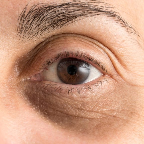 UNDER EYE CIRCLES