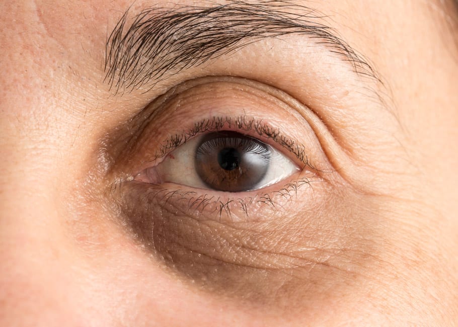 UNDER EYE CIRCLES