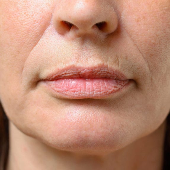 FACIAL VOLUME LOSS