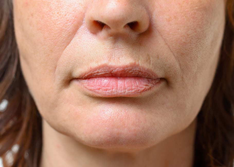 FACIAL VOLUME LOSS