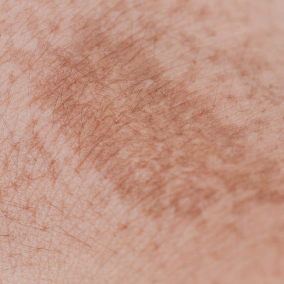 HYPERPIGMENTATION
