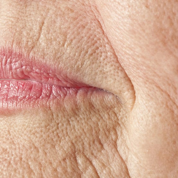 UPPER LIP LINES