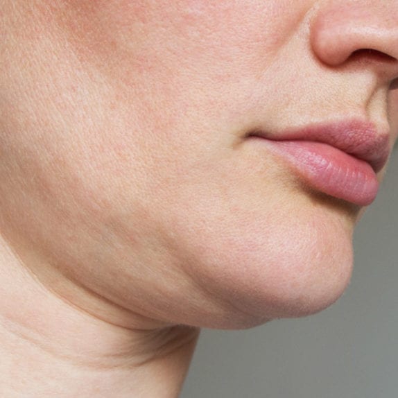 LOOSE OR SAGGING SKIN