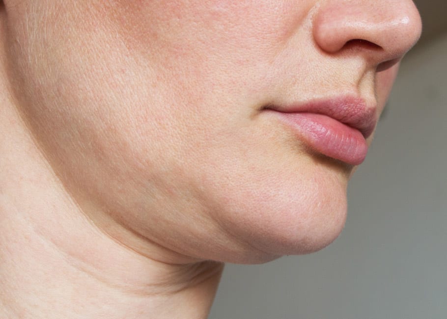 LOOSE OR SAGGING SKIN