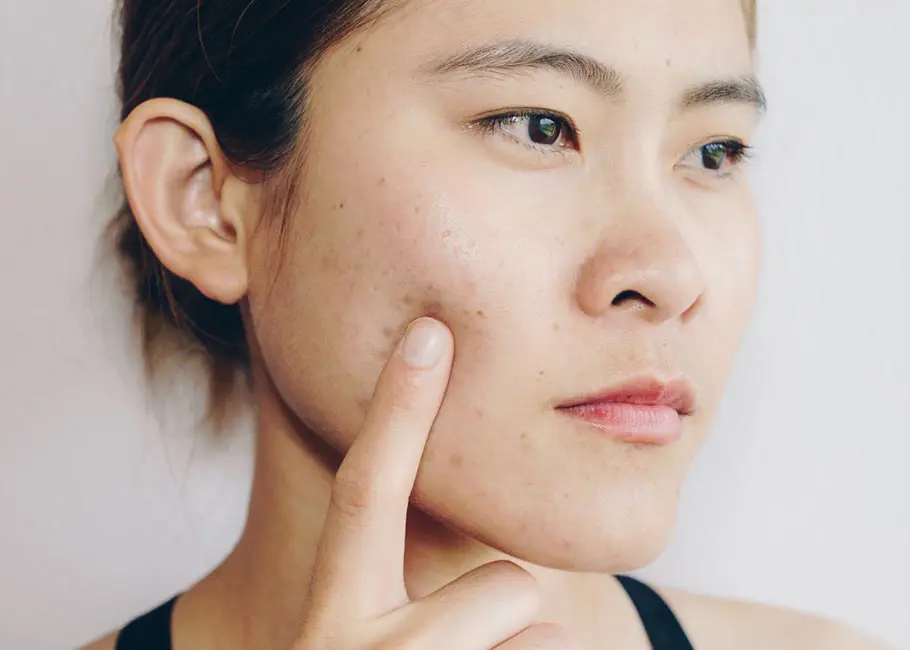 Acne scars