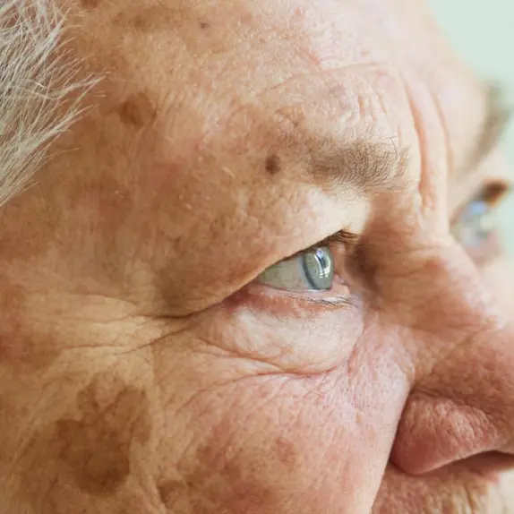 Age Spots