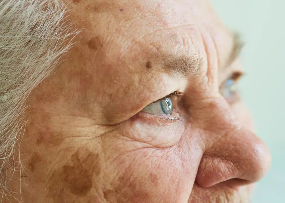 Age Spots
