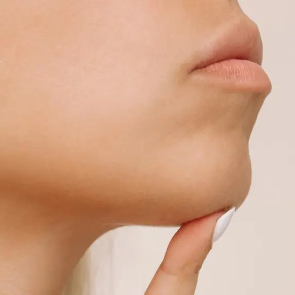 Chin Set Back