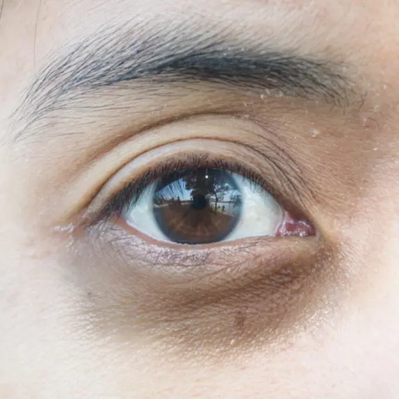 Dark Circles