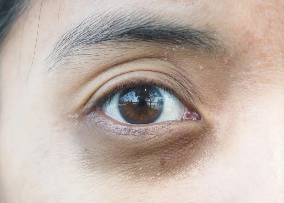 Dark Circles