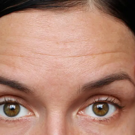 Forehead Lines