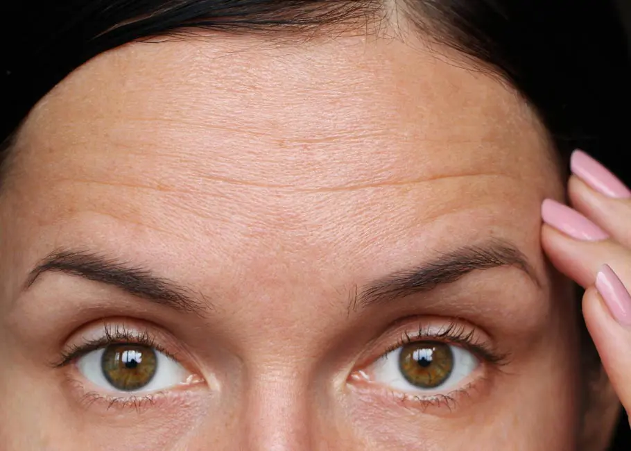 Forehead Lines