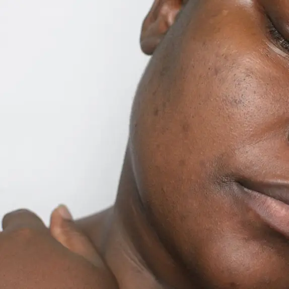 Melasma