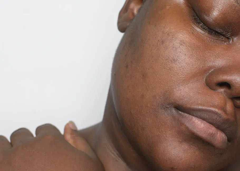 Melasma