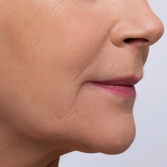 Mouth to Chin Marionette Lines