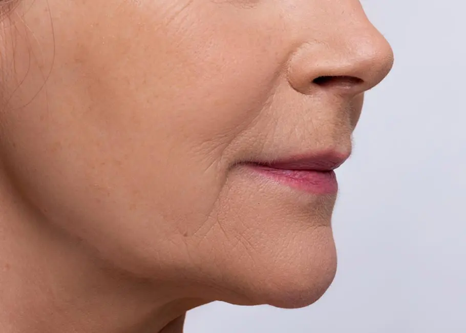 Mouth to Chin Marionette Lines