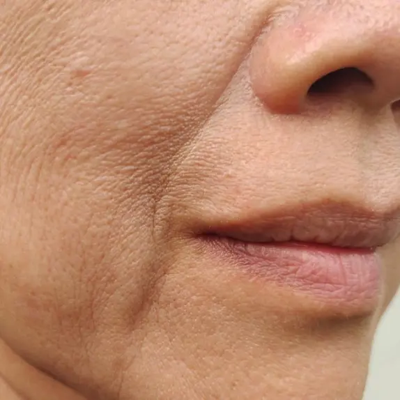 Nose to Mouth Lines