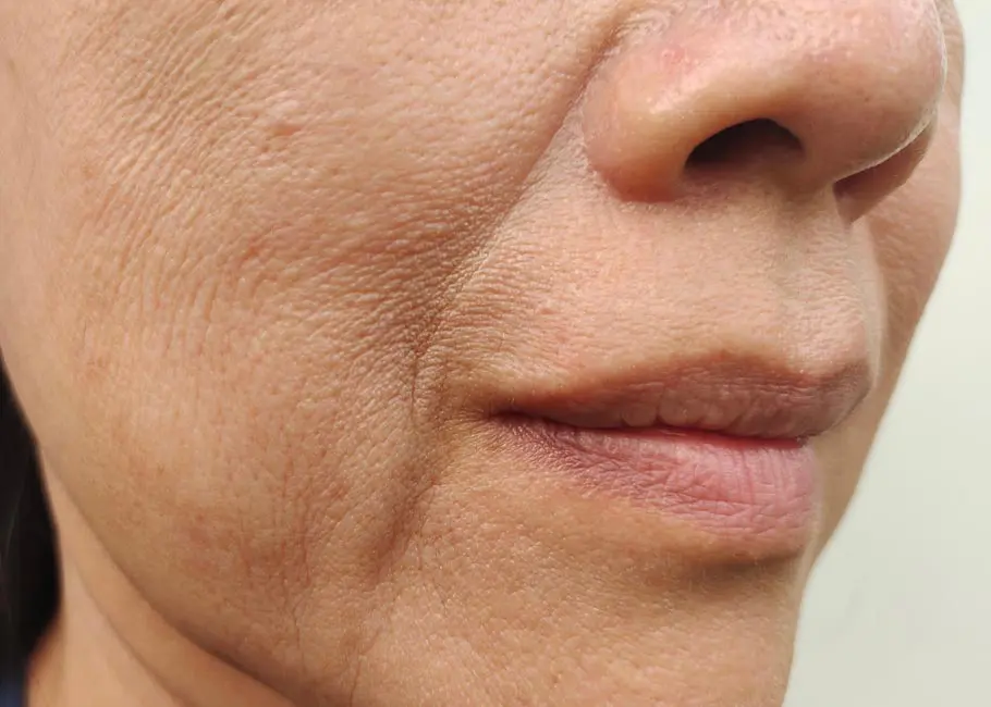 Nose to Mouth Lines