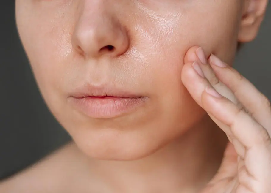 Oily Skin