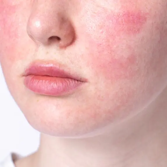 Redness