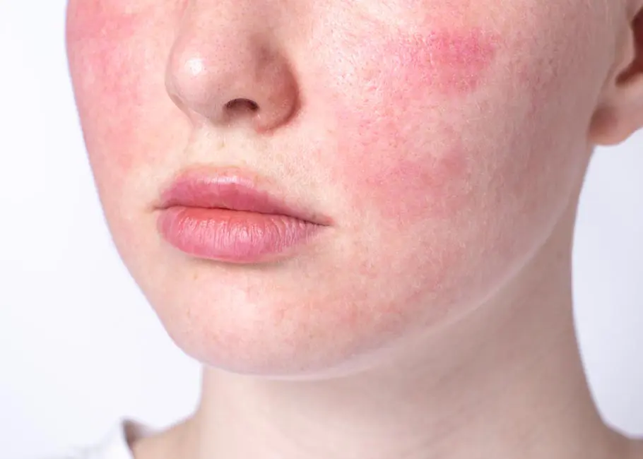 Redness