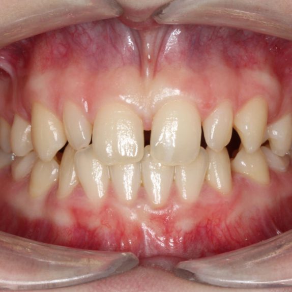 Diastema or ‘Gappy’ Teeth