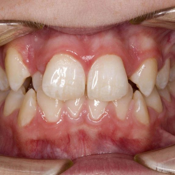 Crooked Teeth