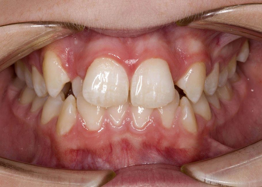 Crooked Teeth